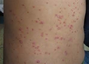 牛皮癣的原因有哪些