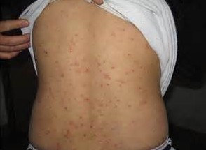 疥疮对人的身体危害有那些