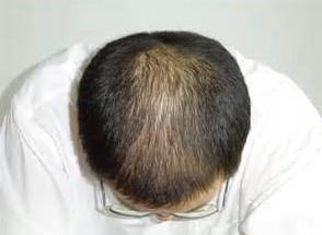 脱发需要做什么检查