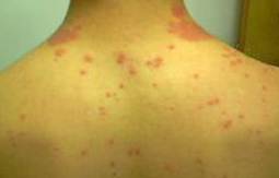 慢性湿疹的治疗