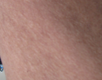 鱼鳞病能不能治