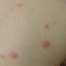 治疗疱疹的方法