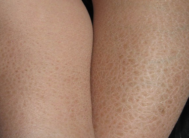 预防鱼鳞病的措施有什么