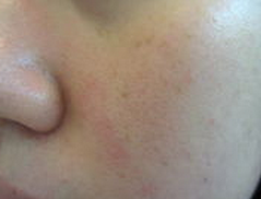 淡化雀斑的方法都有哪些