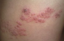 疱疹患者如何饮食好