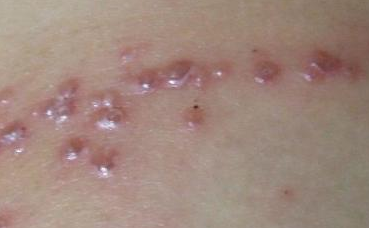 治疗疱疹的主要方法