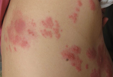 带状疱疹疾病发病原因有哪些