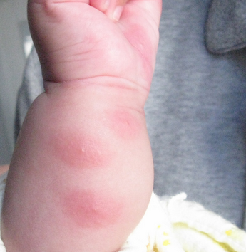 为什么会患上湿疹