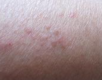 湿疹治疗误区有什么