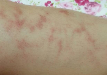 ʪ���֢״��ʲô��