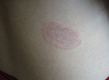 股癣用什么药比较好