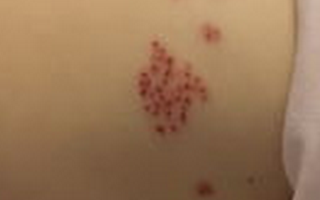 带状疱疹如何治疗