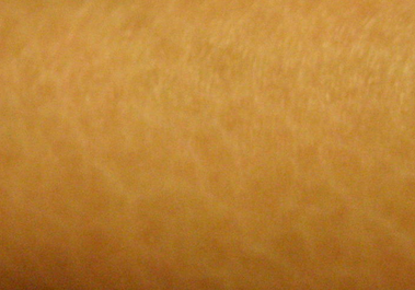 鱼鳞病疾病会给患者带来哪些伤害