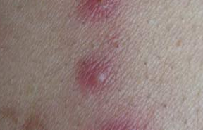 导致皮肤毛囊炎出现的主要因素