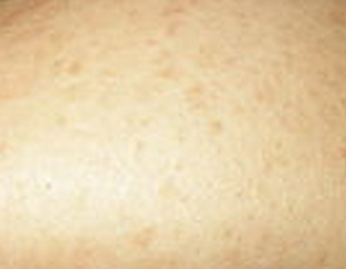 鱼鳞病的发病原因是什么