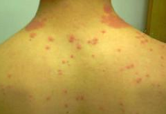 导致急性湿疹的原因有哪些