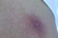 要怎样来治疗疥疮呢