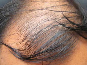 脂溢性脱发到底能治好吗