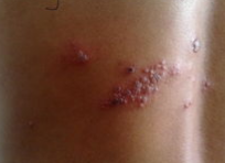 治疗带状疱疹疾病的中药有哪些