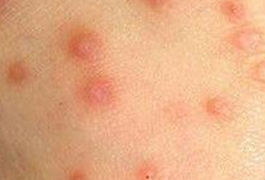 生活中如何防治疥疮