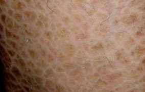 鱼鳞病的症状有哪些