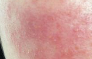 ������Ƥ������γ��ֵ�