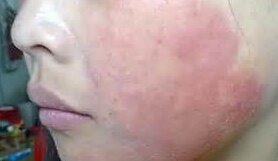 干性湿疹发病的原因有那些