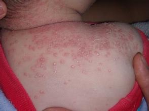 治疗湿疹方法有哪些