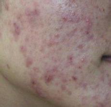 天津面部痤疮怎么治