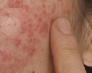 过敏性皮炎怎样治