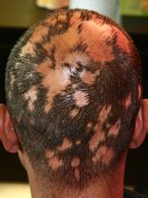 头顶斑秃怎么办