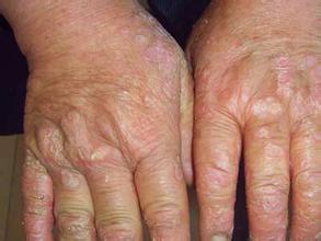 天津怎样治疗肛门湿疹