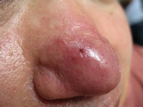 天津如何去除酒糟鼻