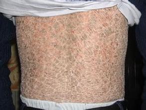 天津鱼鳞病可以治疗好吗