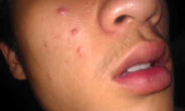 天津如何治好青春痘