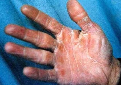 �ǻ�������Ѣ֢״ͼƬ