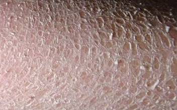 天津鱼鳞病的治疗方法