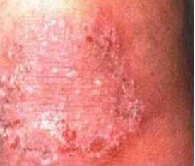 �����Ѣ��ԭ����ʲô