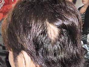 斑秃治疗快的偏方