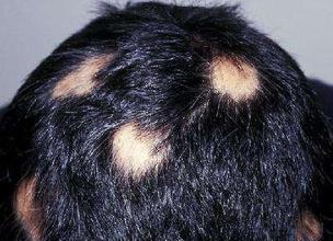 治疗斑秃的药物有哪些