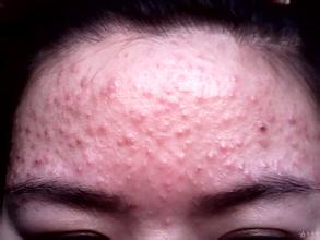 毛囊炎是什么样的