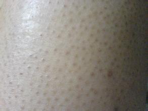 鱼鳞病危害有哪些