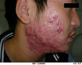 天津怎么去除痤疮疤痕