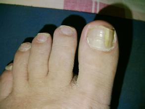 天津治灰指甲多少钱