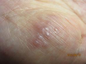 疥疮是什么原因