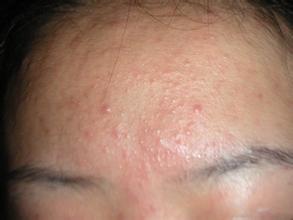 天津痤疮的治疗方法