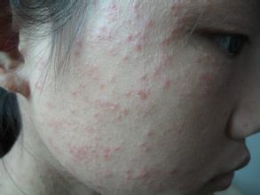 天津痤疮多少钱