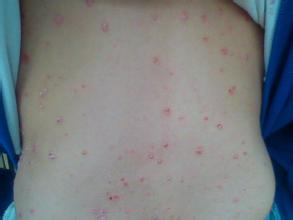 ţƤ޺�ĳ���֢״����Щ