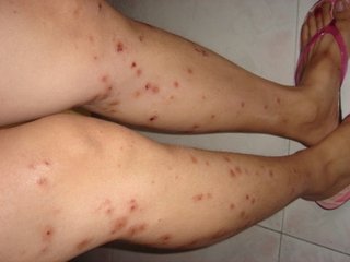 得了过敏性皮炎怎么治