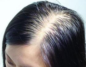 常脱发是什么原因